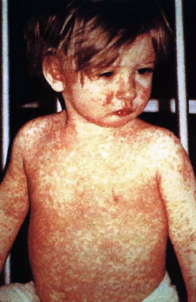 Bangladesh measles outbreak exceeds 120,000 cases, 300+ deaths, launches emergency vaccination and tracing.