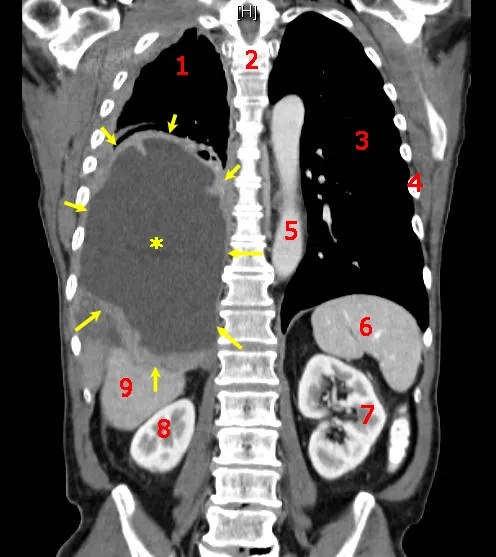 Manchester Hospital Pioneers ZI-MA4-1 Advanced Cancer Treatment in UK.